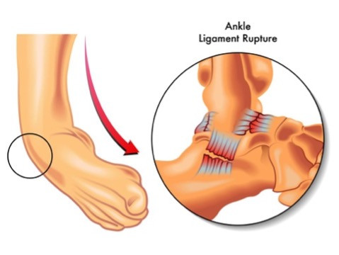 治未病-自然療法-運動科學-腳踝扭傷